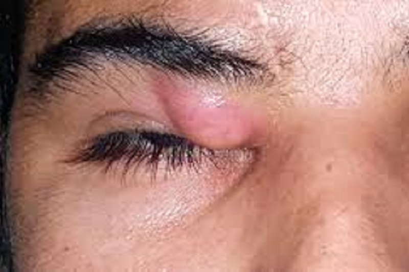 Eye Tumor management